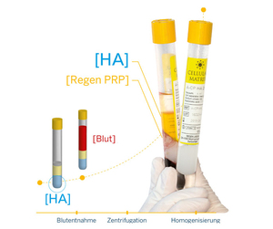 Cellular Matrix bei Kniearthrose